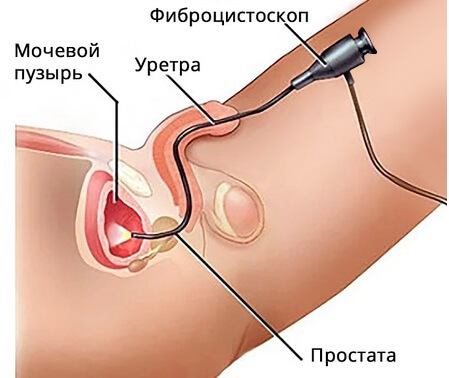 Фиброцистоскопия мочевого пузыря у мужчин