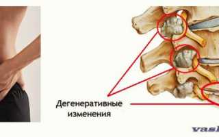 Спондилез поясничного отдела позвоночника – что это такое и как его лечат?