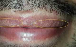 Возможные причины сыпи на губах