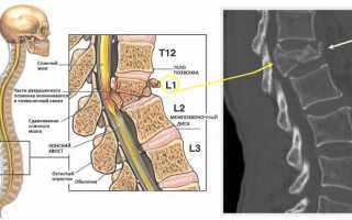 Компрессионный перелом позвоночника поясничного отдела: лечение и физическая реабилитация