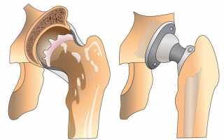 Эндопротезирование тазобедренного сустава: от чего зависит успешность операции?