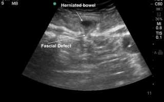 УЗИ кишечника: что покажет