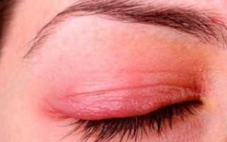 Аллергический блефарит: когда от аллергии страдают глаза