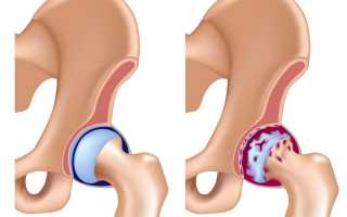 Артроз тазобедренного сустава — механизм развития патологии, основные проявления по стадиям, методы лечения