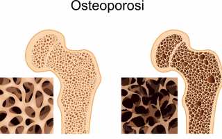 Остеопороз костей: причины, симптомы, лечение, осложнения