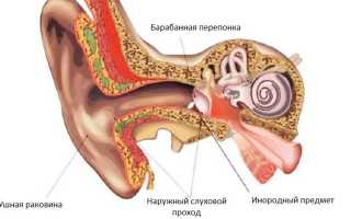 Как вытащить инородное тело из уха?