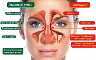 Как распознать и вылечить пансинусит?