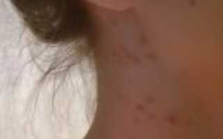 Серьезное поражение кожи лица: себорейный дерматит, или что мы о нем не знали