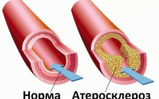 Глюконат кальция: восполняем дефицит кальция для борьбы с аллергией