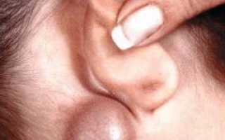 Почему за ухом появилась шишка и что это может быть?