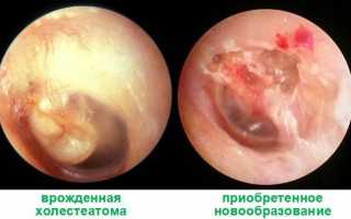 Что такое холестеатома уха?