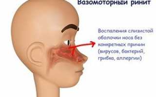 Что такое вазомоторный ринит и какими методами его можно вылечить