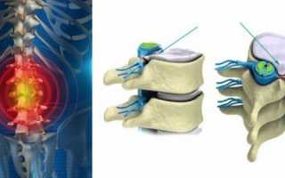 Боли при грыже поясничного отдела позвоночника: секреты быстрого и эффективного купирования