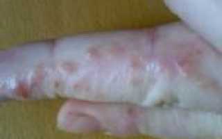 Опасные гнусы: аллергия на укусы мошек