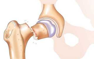 Перелом тазобедренного сустава – характеристика и современные методы лечения