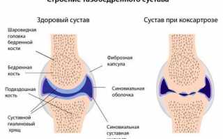 Коксартроз коленного сустава: особенности заболевания, причины развития и методы лечения