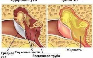 Как лечить тубоотит у детей?