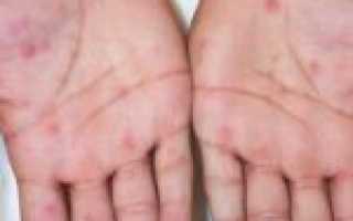 Заболевания, вызывающие аллергию на руках: как они выглядят и способы их лечения