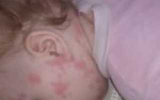 Аллергия на Нурофен у ребенка — недетская проблема