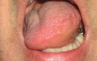 Опух язык: аллергия, глоссит и еще 4 основные причины