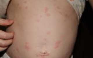 Аллергия на сливочное масло: трудность, от которой рацион страдает не сильно