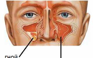 К какому врачу обращаться при гайморите?