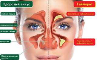Как лечить левосторонний гайморит?