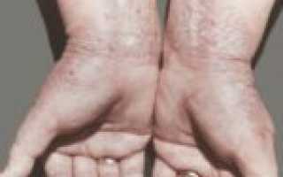 Нейродермит на руках: причины появления и комплексное лечение