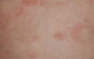Накопительная аллергия: терпение организма не безгранично