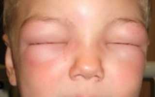 Почему возникает крапивница у детей: симптомы и лечение