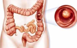Полипы в кишечнике: виды, симптомы и лечение