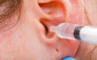 Как лечить отит уха перекисью водорода?