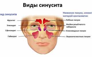 Как лечить верхнечелюстной синусит?