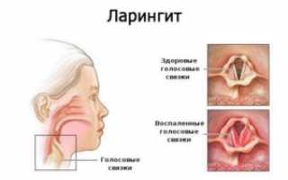 Горло в опасности: аллергический фарингит и его осложнения