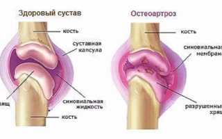 Деформирующий остеоартроз коленного сустава: симптомы, причины развития, формы и стадии, методы лечения