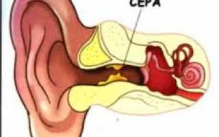 Как достать ушную серную пробку в домашних условиях?