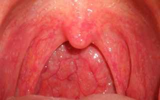 Как лечить стрептококк в горле