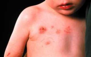 Пузырчатый дерматит: необычные виды заболевания, методы лечения и профилактики