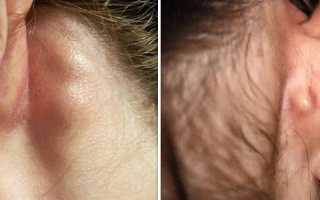 Как лечить шишку за ухом и на мочке?