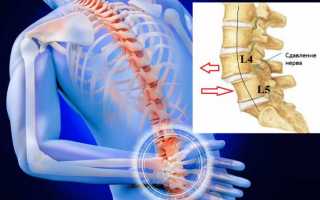 Ретроспондилолистез: что такое, как его распознать, лечить и предотвратить