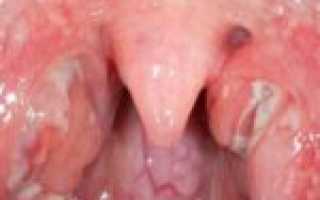 Аллергический отек гортани — грозный симптом
