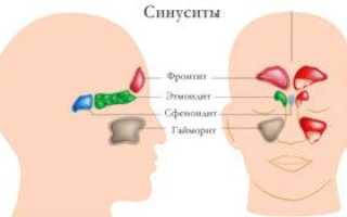 Что такое двусторонний синусит и как его лечить?