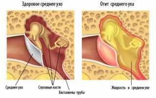 Как избежать отита у ребенка?