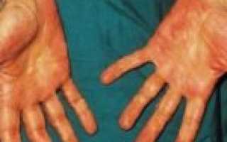 Красные ладони рук: болезнь или безопасный и временный дефект