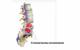 Гемангиома позвоночника: что это такое, и стоит ли опасаться этого диагноза