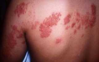 Мазь Псориатен: средство для борьбы с кожными заболеваниями