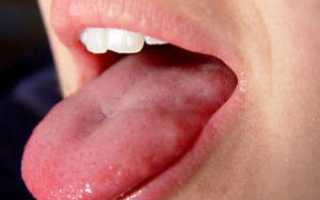 Как лечить воспаление язычка в горле