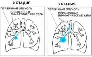 Чем лечить свист в носу при выдохе?