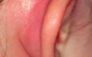 Как выглядит и лечится рожистое воспаление ушной раковины?
