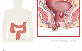 Как предупредить формирование геморроидальных шишек